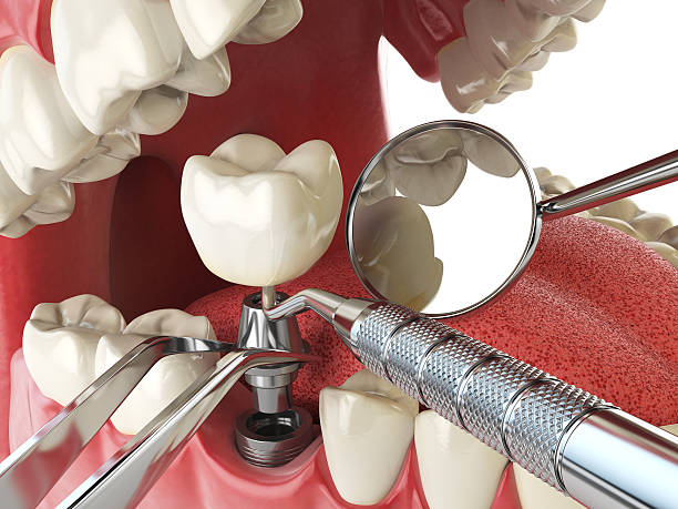 Best Emergency Root Canal Treatment in Blaine, WA